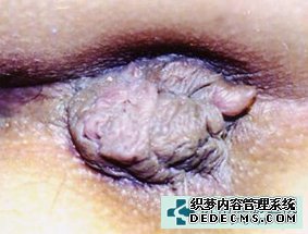 瘙痒症或肛门湿疹;女性